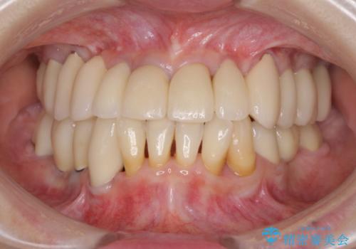 どんなに歯を磨いても治らない　重度歯周病患者の治療の治療後