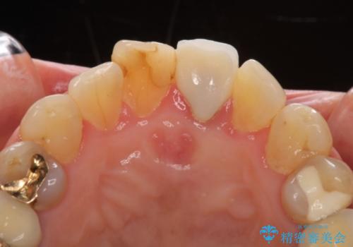 歯茎の腫れた前歯を綺麗にしたい　部分矯正を用いたセラミック治療の治療前