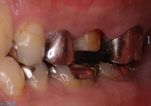根管治療からやり直し　奥歯の被せ物までの治療中