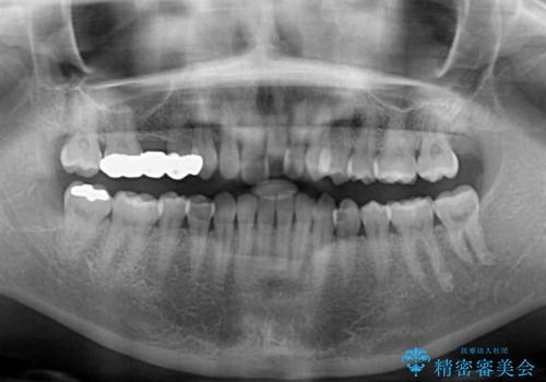 上の前歯の出っ歯を抜歯矯正で改善の治療前