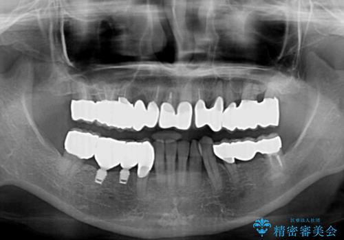 どんなに歯を磨いても治らない　重度歯周病患者の治療の治療後