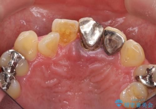 [歯牙破折]  歯槽堤保存術を応用した上顎前歯ブリッジの治療前