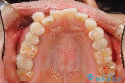 歯を抜かずに八重歯をきれいに!　インビザラインによる全顎矯正治療の症例 治療前