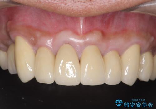 多発した深い虫歯　歯周外科による歯肉改善セラミック補綴の症例 治療後