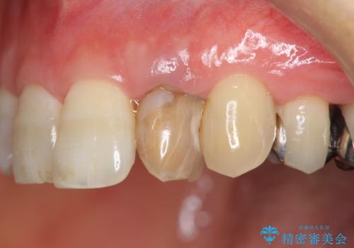 前歯の色変化　セラミッククラウンによる審美性の改善の症例 治療前