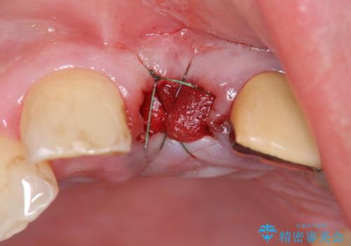 [歯牙破折]  歯槽堤保存術を応用した上顎前歯ブリッジの治療中