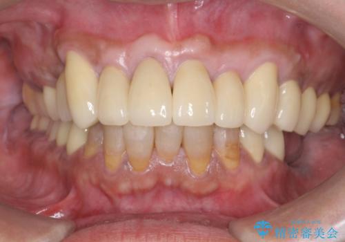 多発した深い虫歯　歯周外科による歯肉改善セラミック補綴の治療後