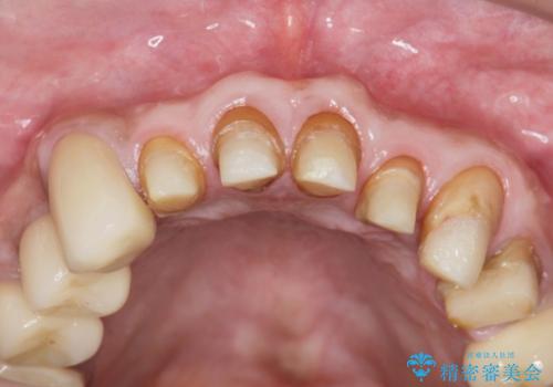 多発した深い虫歯　歯周外科による歯肉改善セラミック補綴の治療中