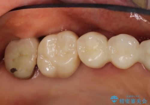 上の奥歯が保存不可能に→サイナスソケットリフトで薄い骨にも対応の治療後