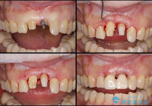 歯茎の腫れた前歯を綺麗にしたい　部分矯正を用いたセラミック治療の治療中
