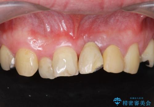 [歯牙破折]  歯槽堤保存術を応用した上顎前歯ブリッジの症例 治療前