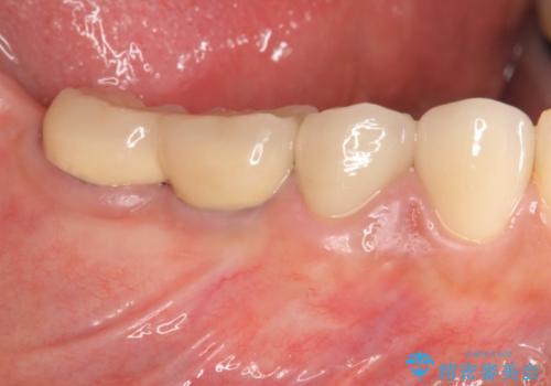 下顎大臼歯欠損　インプラントによる咬合機能回復の治療後