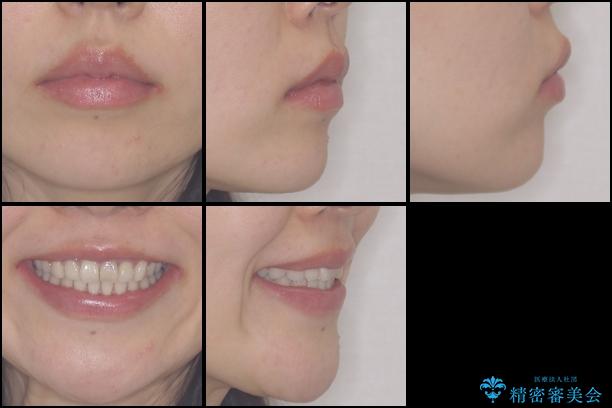 前歯の歯並びと変色を改善　インビザラインとオールセラミックの治療後（顔貌）