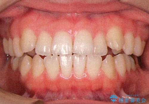 表側のワイヤー矯正　口元の改善をはかる抜歯矯正の治療前