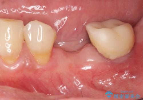[歯の欠損] インプラントによる咬合回復の治療前