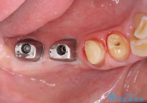 奥歯の欠損　インプラントによる機能回復の治療中
