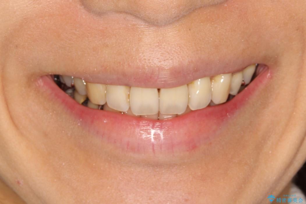 ハーフリンガル ワイヤー矯正　出っ歯の矯正治療の治療後（顔貌）