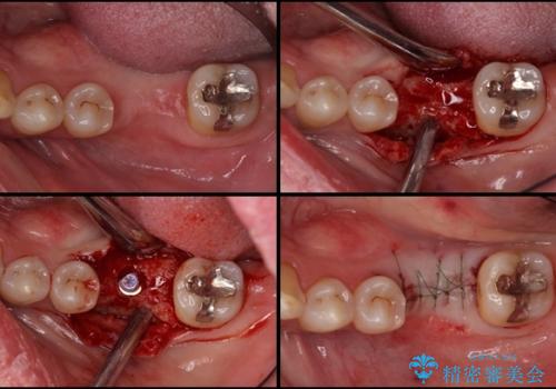 奥歯の割れてしまった歯　ストローマンインプラントによる咬合回復の治療中