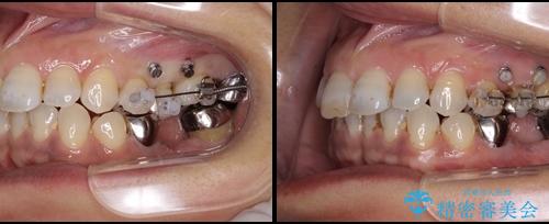 奥歯が抜けそう　部分矯正による咬み合わせの改善とインプラントによる補綴治療の治療中