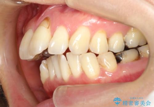 ハーフリンガル ワイヤー矯正　出っ歯の矯正治療の治療前
