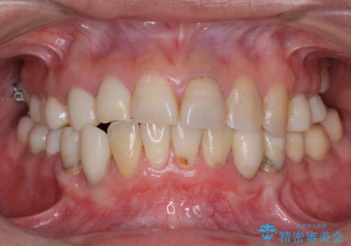 全顎的に多発した虫歯治療の治療中