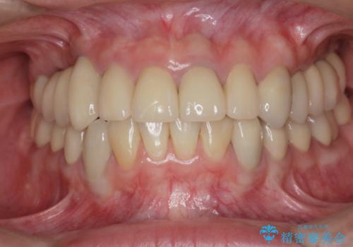 全顎的に多発した虫歯治療の治療後