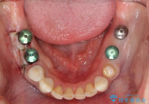 下顎大臼歯欠損　インプラントによる咬合機能回復の治療中