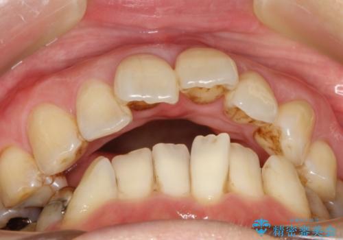 ハーフリンガル ワイヤー矯正　出っ歯の矯正治療の治療前