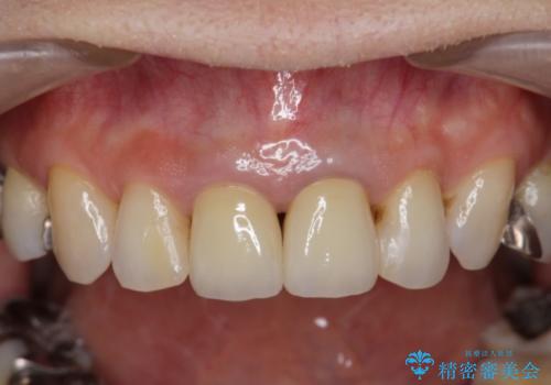 [前歯　オールセラミック治療]  前歯に天然歯のような透明感を創るの治療後