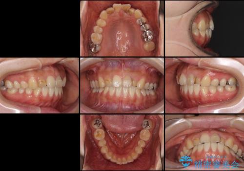 前歯の歯並びと変色を改善　インビザラインとオールセラミックの治療前