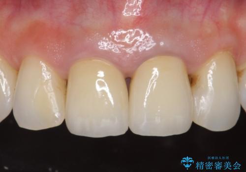 [前歯　オールセラミック治療]  前歯に天然歯のような透明感を創る