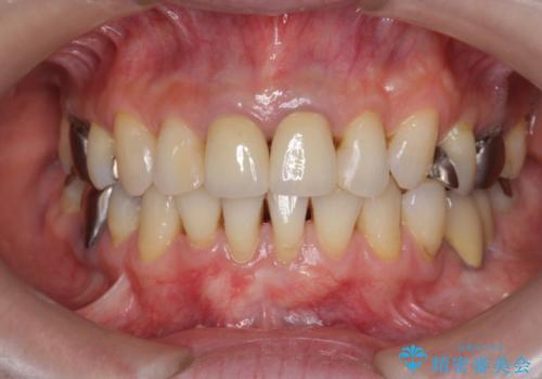 [前歯　オールセラミック治療]  前歯に天然歯のような透明感を創るの治療後