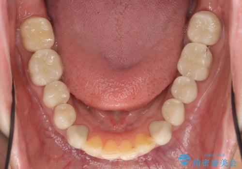 全顎的に多発した虫歯治療の治療後