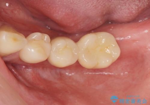 [歯の欠損] インプラントによる咬合回復の治療後