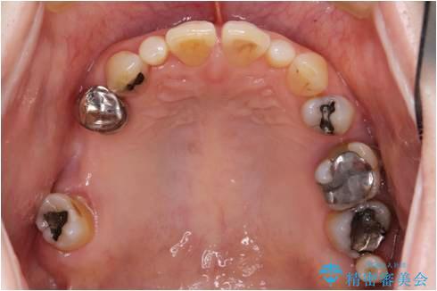 全顎歯周病治療の治療前
