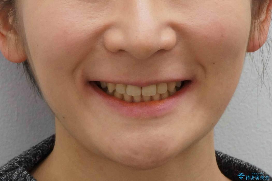 出っ歯・過蓋咬合　奥歯を後ろに下げて非抜歯で治療の治療後（顔貌）