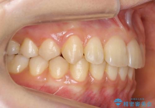 出っ歯・過蓋咬合　奥歯を後ろに下げて非抜歯で治療の治療後