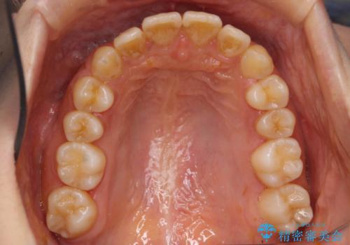 出っ歯・過蓋咬合　奥歯を後ろに下げて非抜歯で治療の治療後