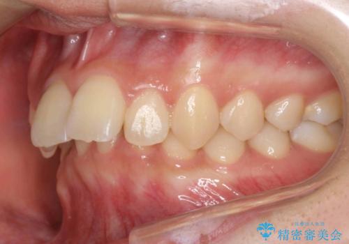 出っ歯・過蓋咬合　奥歯を後ろに下げて非抜歯で治療の治療前