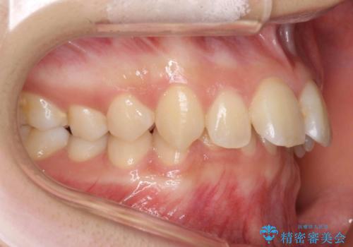 出っ歯・過蓋咬合　奥歯を後ろに下げて非抜歯で治療の治療前