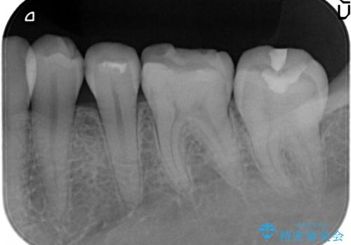 下顎小臼歯　セラミックインレー修復の治療前