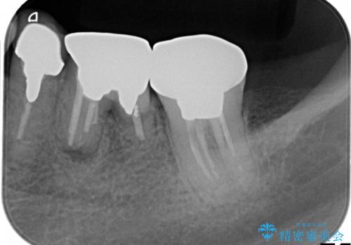 ショートインプラントによる奥歯の咬み合わせの回復治療の治療前