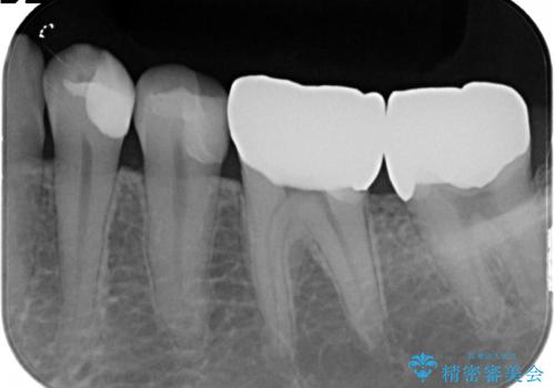 劣化した詰め物と虫歯の治療の治療後