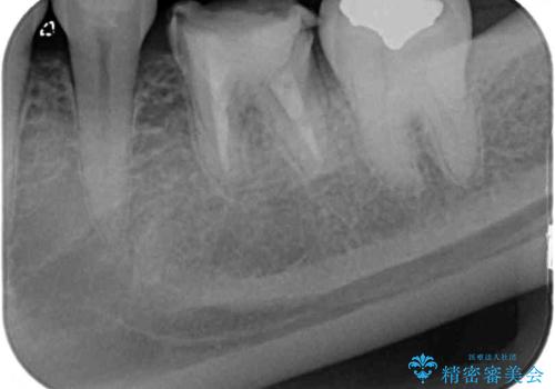 奥歯の割れてしまった歯　ストローマンインプラントによる咬合回復の治療前