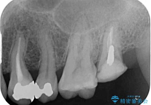 奥歯が痛い　歯の欠損と虫歯による奥歯の痛みを改善の治療前