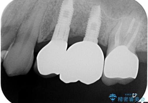 歯根破折により抜歯となってしまった奥歯のインプラントによる咬み合わせ回復の治療後