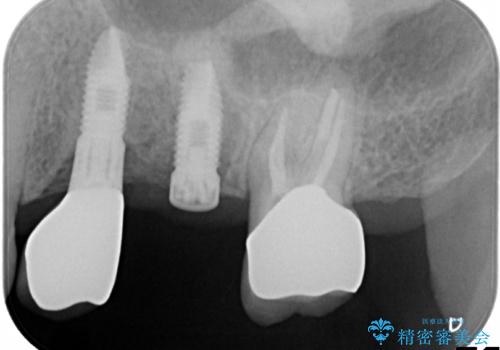 歯根破折により抜歯となってしまった奥歯のインプラントによる咬み合わせ回復の治療中