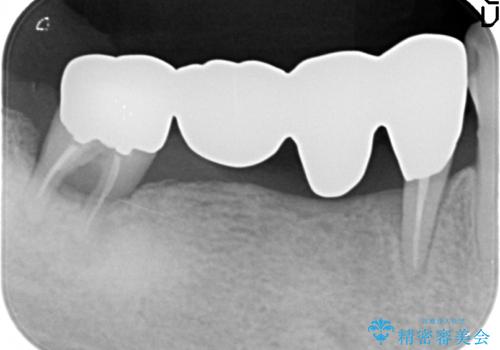 奥歯で噛めない　インプラントとセラミックによる咬み合わせの回復の治療前