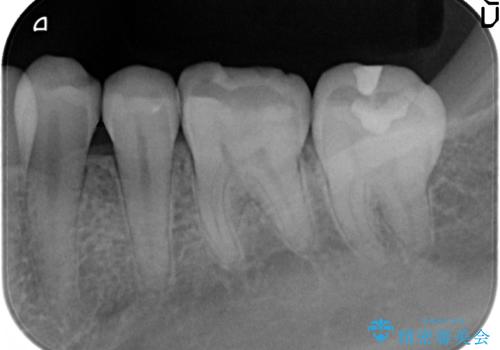 下顎小臼歯　セラミックインレー修復の治療後