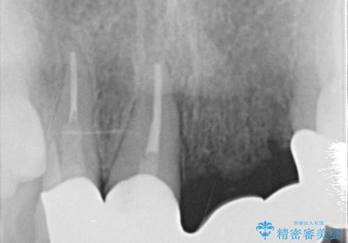 前歯のセラミックブリッジ　長すぎる前歯を部分矯正で修正するの治療前